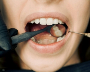 checking for cavities with mirror and dental tool